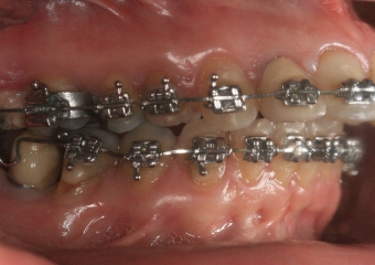 Mordida perfil inicial - Clínica Cliniface