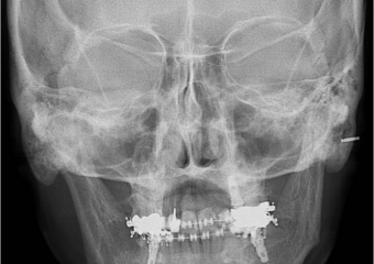 Telerradiografia frontal inicial - Clínica Cliniface