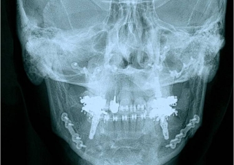 Telerradiografia frontal após a cirurgia - Clínica Cliniface