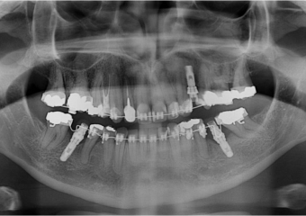 Raio x panorâmico inicial - Clínica Cliniface