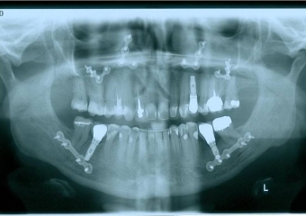 Raio x panorâmico final - Clínica Cliniface