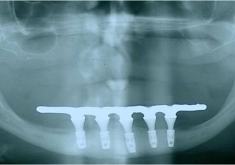 Raio X  final com prótese fixa em resina instalada, sobre implantes Cone Morse - Clínica Cliniface