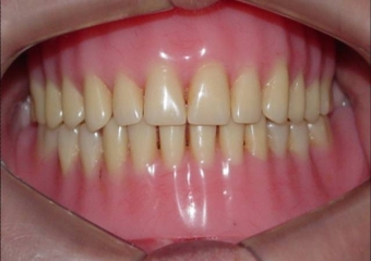 Próteses totais iniciais - Clínica Cliniface