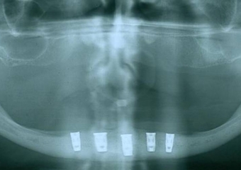 Raio X dos implantes Cone Morse - Clínica Cliniface