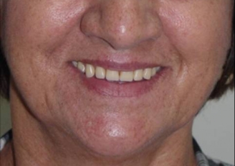 Sorriso inicial - Clínica Cliniface