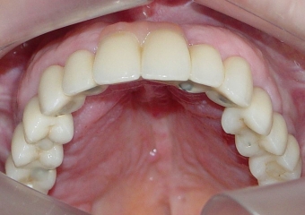 Imagens da prótese fixa superior em porcelana sobre implantes Cone Morse - Clínica Cliniface