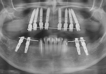 Raio X com implantes Cone Morse superiores e próteses provisórias - Clínica Cliniface