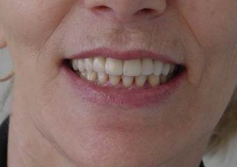 Sorriso final do caso terminado em março de 2012 - Clínica Cliniface