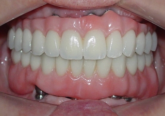 Próteses fixas em porcelana sobre implantes - Clínica Cliniface