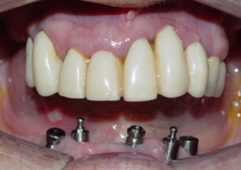 Imagens iniciais, dos dentes e implante comprometidos realizados por outro profissional - Clínica Cliniface
