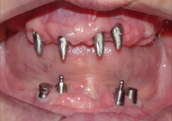 Imagens após remoção dos dentes e do implante comprometido - Clínica Cliniface