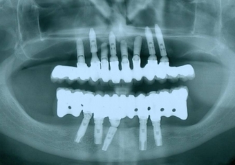 Raio X com implantes Cone Morse e próteses fixas em porcelana - Clínica Cliniface