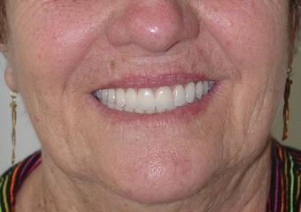 Sorriso do caso finalizado em maio de 2012 - Clínica Cliniface