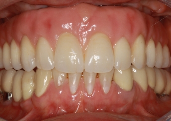 Prótese fixa em porcelana sobre implantes - Clínica Cliniface