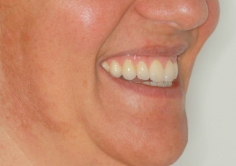Imagens da prótese fixa em porcelana e zircônia sobre implantes, do caso terminado em Fevereiro 2012 - Clínica Cliniface
