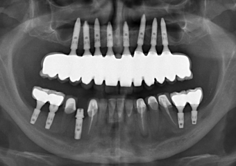 Raio X  final com prótese fixa superior em porcelana e zircônia sobre implantes Cone Morse - Clínica Cliniface