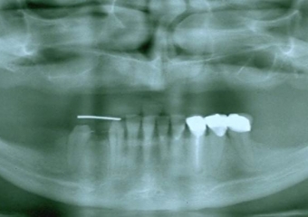 Raio X inicial - Clínica Cliniface