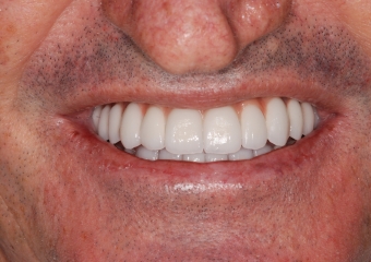 Sorriso final após enxerto de ilíaco, implantes e próteses fixas - Clínica Cliniface