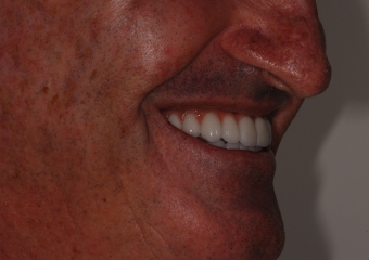 Imagem perfil final do caso terminado em maio 2012 - Clínica Cliniface