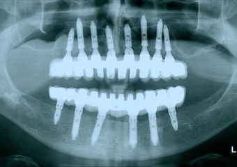 Raio X final com próteses fixas instaladas - Clínica Cliniface