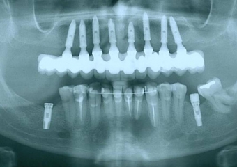 Raio X com prótese fixa em porcelana  - Clínica Cliniface