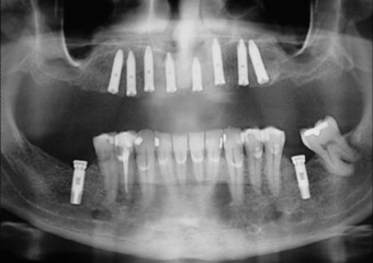  Raio X dos implantes superiores Cone Morse - Clínica Cliniface