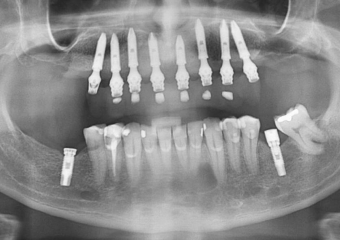 Raio X com prótese fixa provisória superior      - Clínica Cliniface