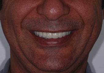 Sorriso final do caso terminado em outubro de 2011 - Clínica Cliniface