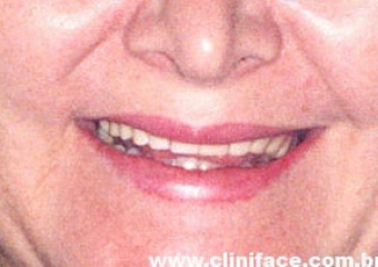 Sorriso com Dentadura - Clínica Cliniface