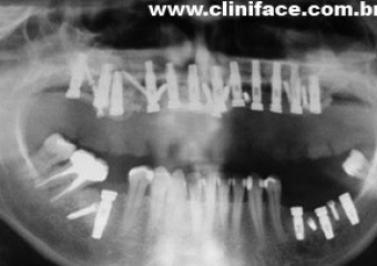 Raio X com Implantes Instalados - Clínica Cliniface