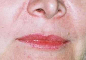 Imagem final do caso terminado em 2006 - Clínica Cliniface