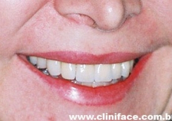 Sorriso com prótese fixa de porcelana sobre implantes - Clínica Cliniface