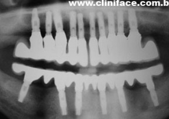 Raio X com implantes e prótese fixa instalado - Clínica Cliniface