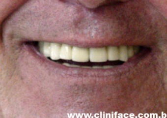 Sorriso com prótese fixa em porcelana sobre implantes do caso terminado em novembro de 2006 - Clínica Cliniface