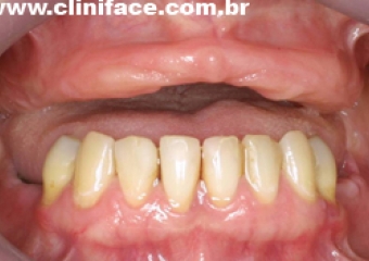 Imagens iniciais intra oral - Clínica Cliniface