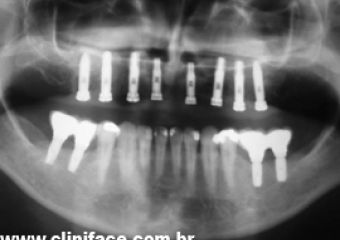 Raio X com implantes instalados - Clínica Cliniface