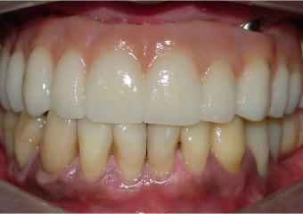 Imagem com dentes de porcelana, fixos sobre implantes - Clínica Cliniface