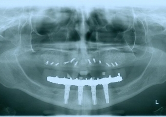 Raio x, após enxerto com osso autógeno de mandíbula e Bio Oss , em Janeiro 2013 - Clínica Cliniface