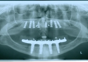 Raio x, com os implantes superiores instalados, em Agosto de 2013 - Clínica Cliniface