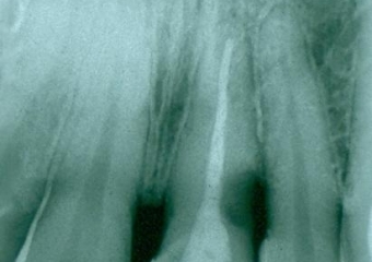 Rx Periapical Inicial 15-06-15 - Clínica Cliniface