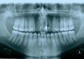 Rx Panoramico Inicial 15-06-15 - Clínica Cliniface