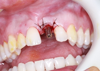 Foto Implante18-05-15 - Clínica Cliniface