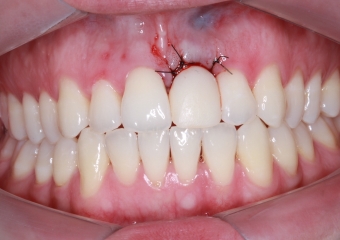 Foto com provisorio imediato 18-05-15 - Clínica Cliniface