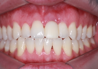 Foto Frontal controle 9 dias 27-05-15 - Clínica Cliniface