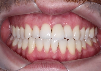 Foto Frontal com Protese definitiva 5 meses 21-11-15 - Clínica Cliniface