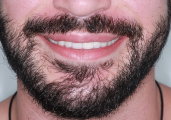 Foto extra oral controle de 1 ano e 7 meses 06-01-17 - Clínica Cliniface