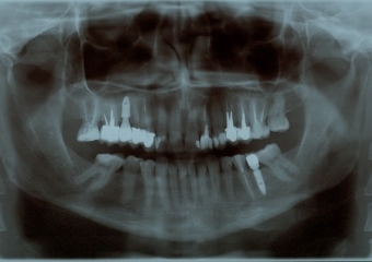 Rx Panoramico Inicial 24-07-15 - Clínica Cliniface