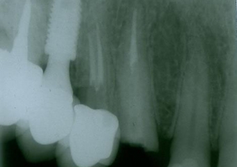 Rx Periapical Pré-cirurgico 03-10-16 - Clínica Cliniface