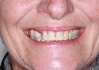 Foto frontal extra oral pré-cirurgica 03-10-16 - Clínica Cliniface