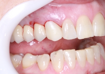 Foto provisorio imediato 03-10-16 - Clínica Cliniface